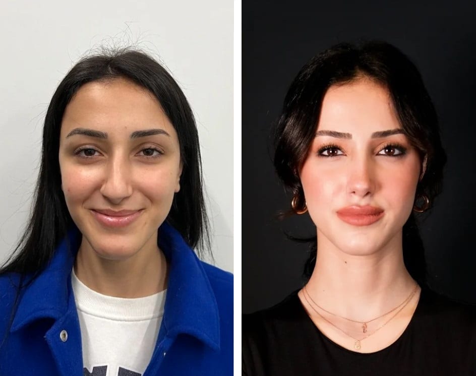 Rinoplastia caso 10 — antes y después